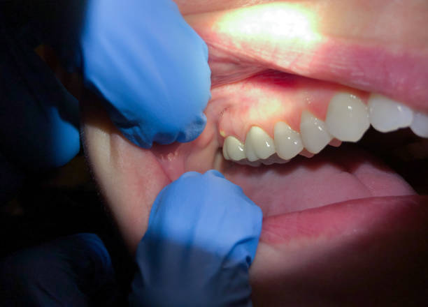 Best Emergency Tooth Extraction in Spring Green, WI
